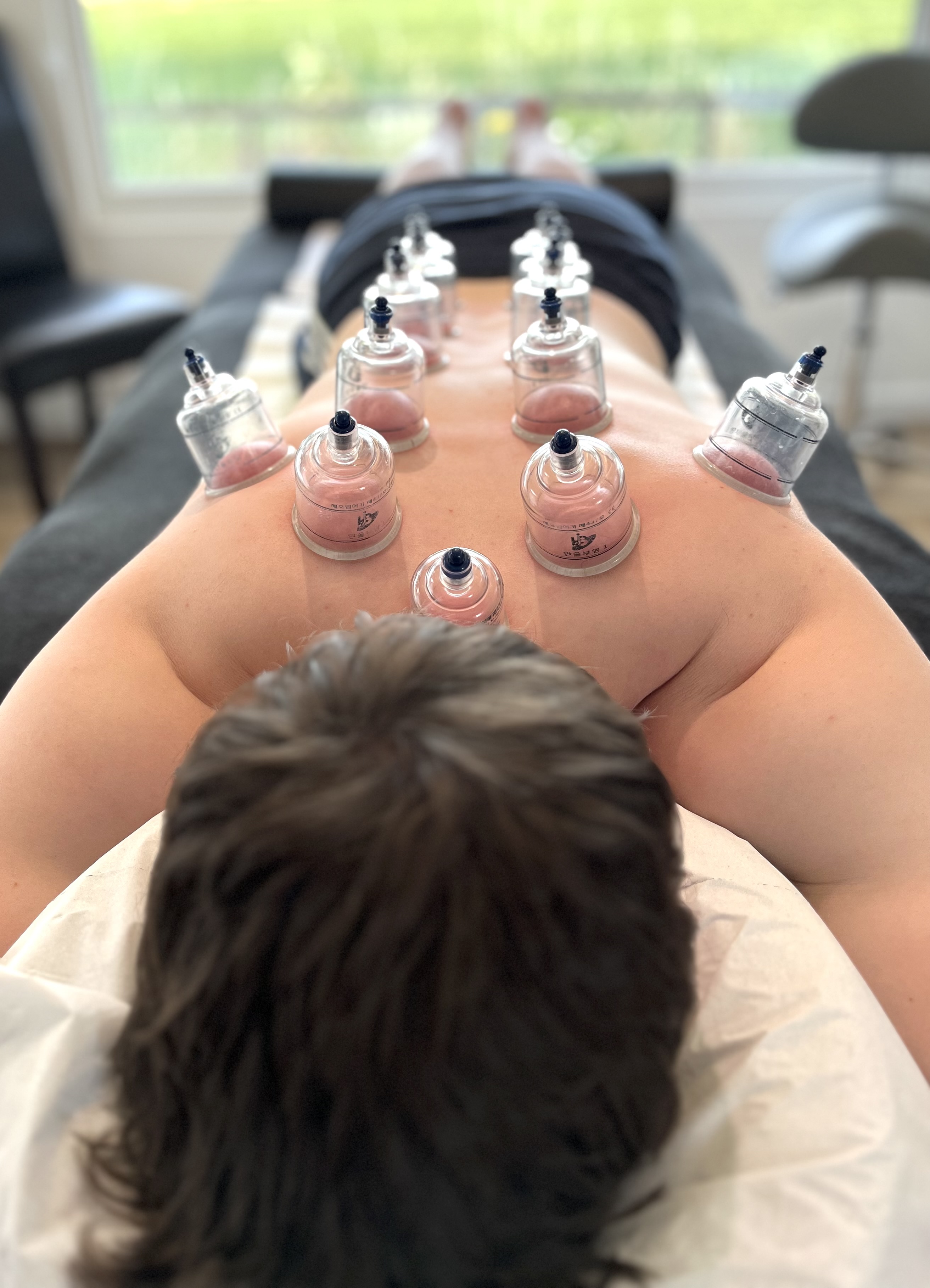Guasha treatment with acupuncture needles in place at Balance Acupuncture