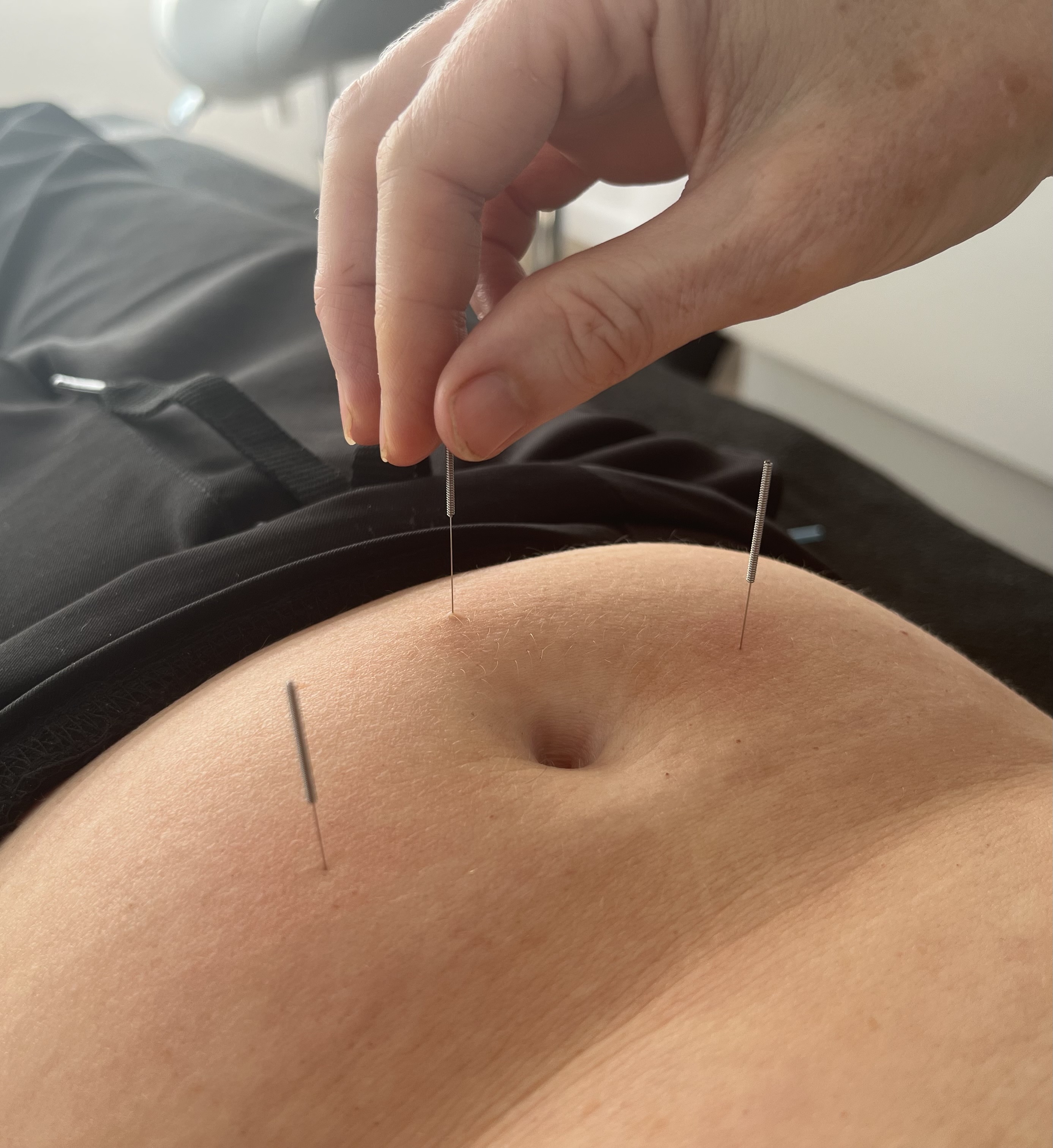 Acupuncture needles being placed during a treatment at Balance Acupuncture