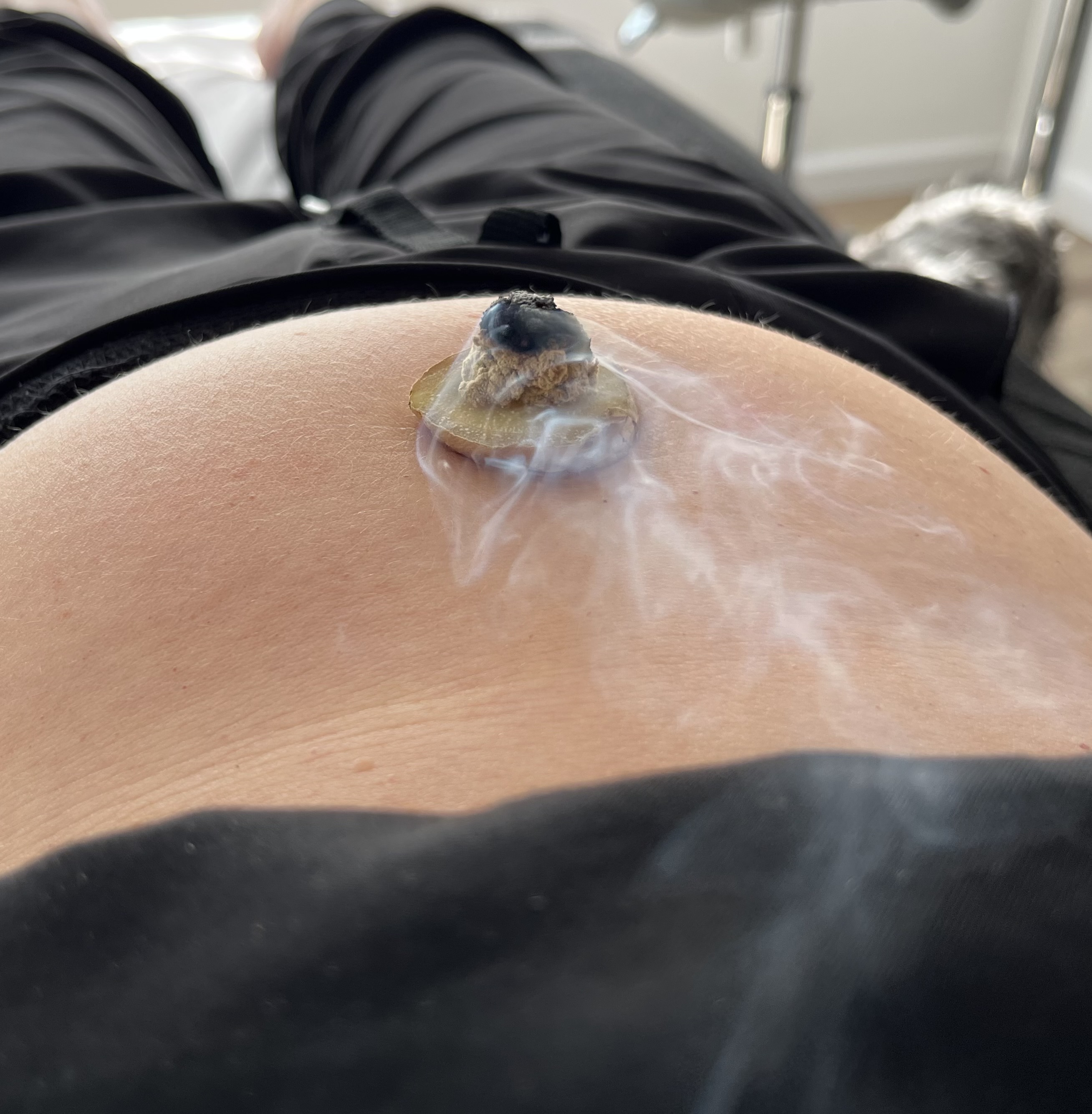 Moxibustion warming therapy being applied at Balance Acupuncture